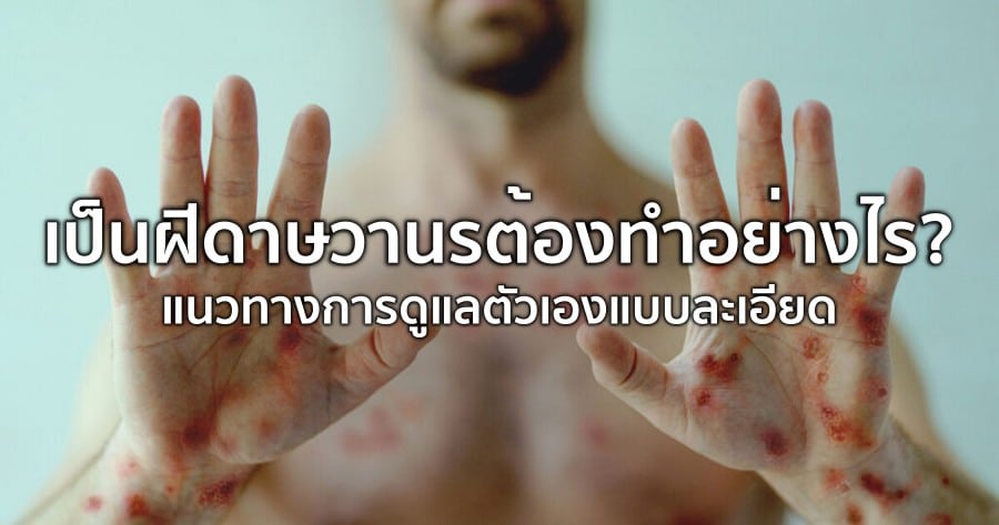 What to Do If You Have Mpox: A Detailed Self-Care Guide